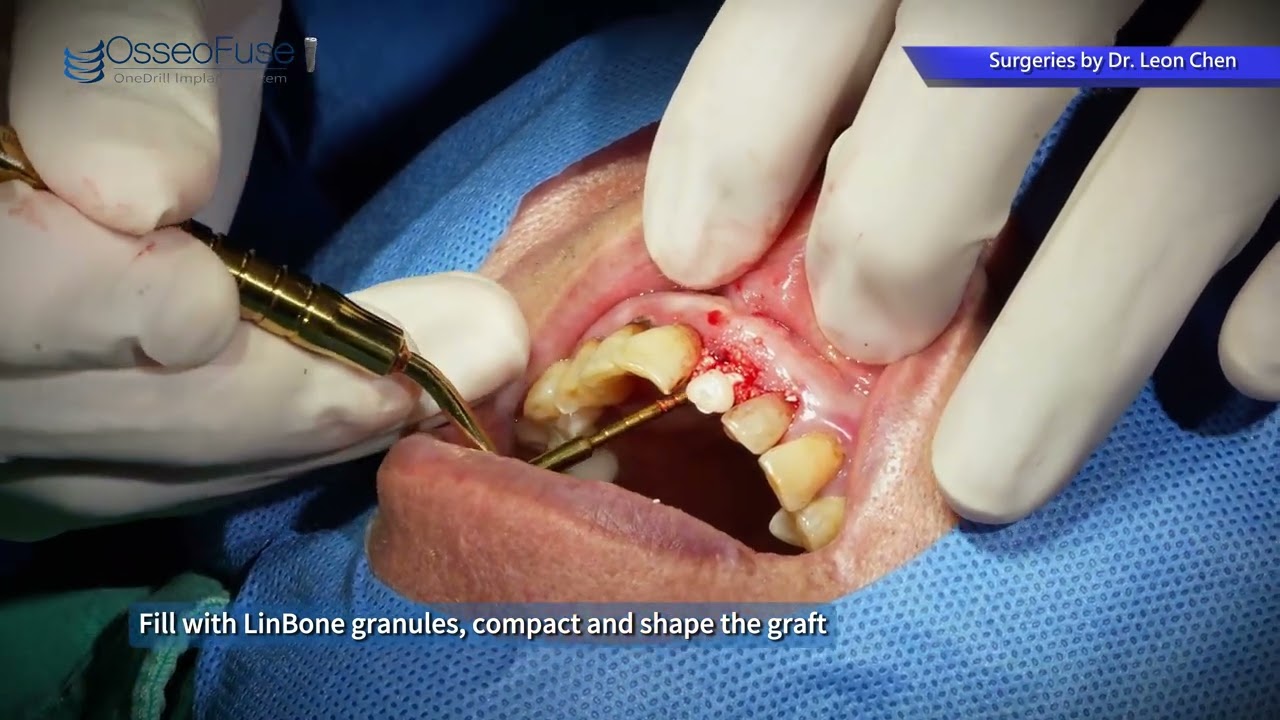 OSUFORT Dental Implant — Brand Film / 歐舒服・一鑽植牙 project by Moss & Grain.